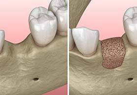 Before and after comparison of bone grafting in Bergenfield