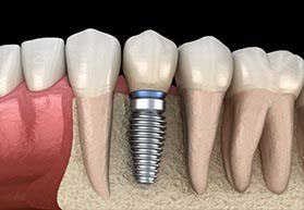Diagram of a single tooth dental implant in Bergenfield