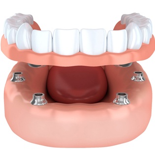 implant-retained dentures six