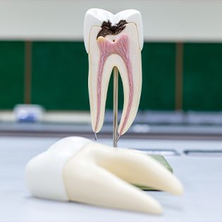 plastic tooth with decay