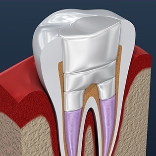 Layers of root canal therapy