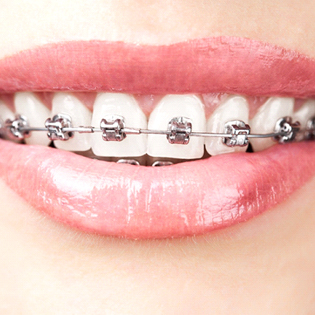 An image of a person’s mouth who is exposing the top row of teeth that have metal brackets and wires on them