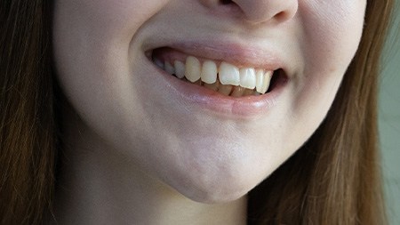 A closeup of a smile with misaligned teeth