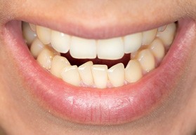 A closeup of a mouth with crowded teeth