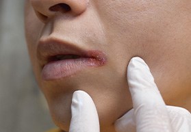 Person with a rough patch on the corner of their mouth