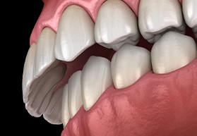 A 3D illustration of an overbite