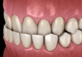 A 3D illustration of an underbite