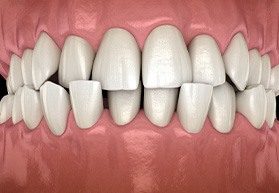 A 3D illustration of a crossbite