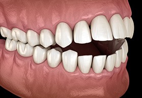 A 3D illustration of a mouth with an open bite