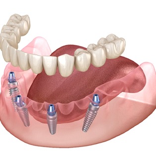 diagram of All-On-4 implants in Bergenfield