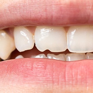 a person with chipped and irregularly shaped teeth