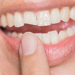 woman with chipped tooth