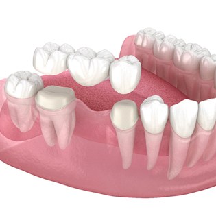 A digital image of a dental bridge going on over health teeth located on the lower arch of a person’s smile in Bergenfield