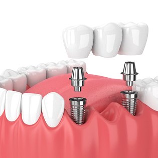 A digital image of an implant bridge sitting on the lower arch of the mouth in Bergenfield