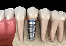 single implant