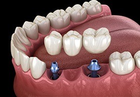 multiple implant