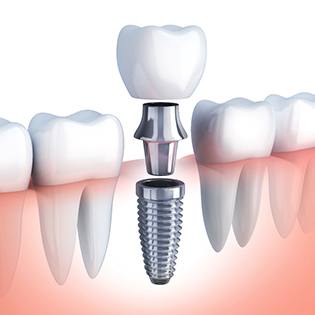 An image of a dental implant with the abutment and custom restoration