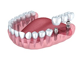 Implant bridge in Bergenfield