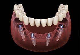 Diagram of an implant denture in Bergenfield