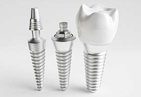 Model dental implants in Bergenfield on gray background