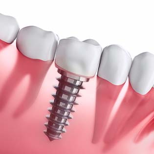 Diagram of dental implants in Bergenfield