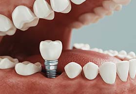 Diagram showing how dental implants in Bergenfield work