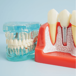 Diagram of dental implants in Bergenfield