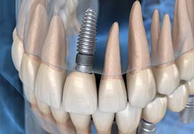 Diagram of dental implants in Bergenfield during osseointegration