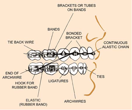 explanation of braces