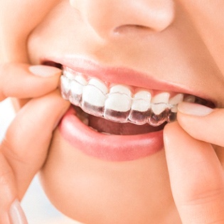 A person inserting an Invisalign aligner