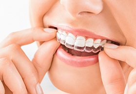 Nose-to-chin closeup of someone smiling removing Invisalign from upper arch