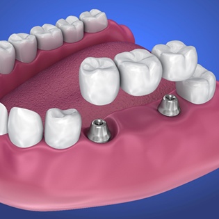 implant-retained bridge