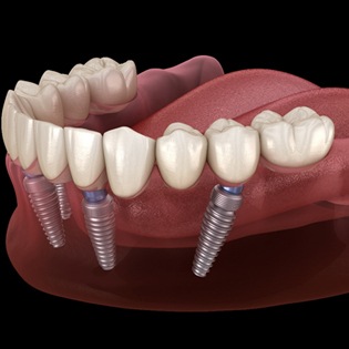 implant-retained dentures