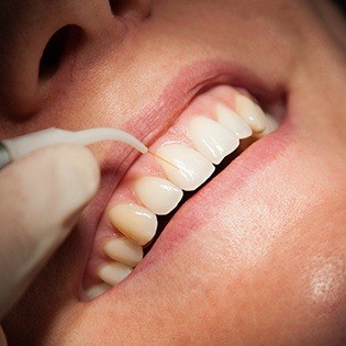 smile getting laser dentistry