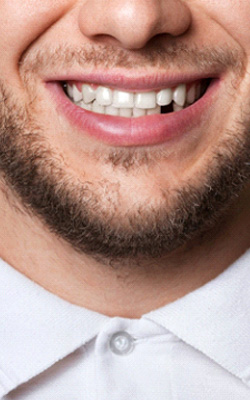 A man with a missing tooth