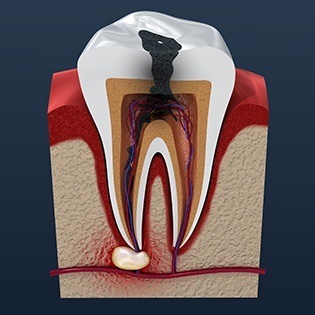 tooth in need of a root canal
