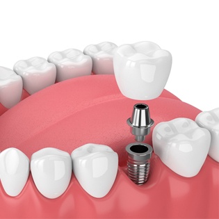 A single tooth implant