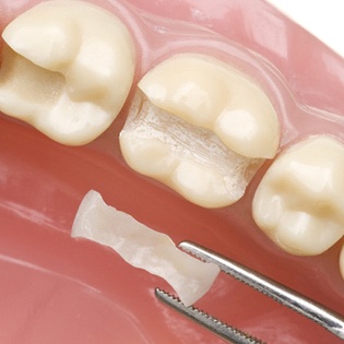 Image of a dental inlay