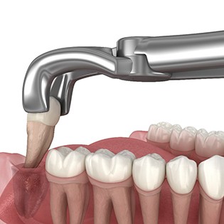 3D render of a tooth being removed