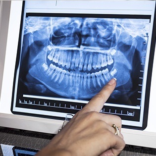 finger pointing to x-ray