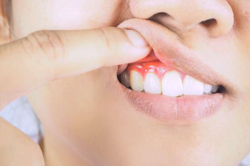 a person holding up their lip to show their red, puffy gums