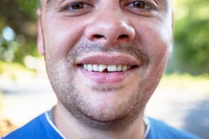a person smiling with a chipped tooth while standing outside