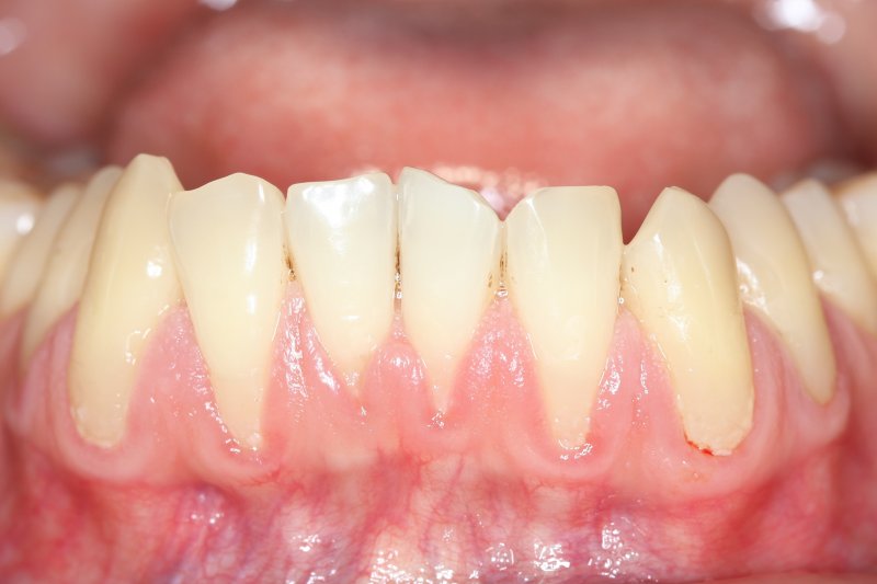 A closeup of receding gums
